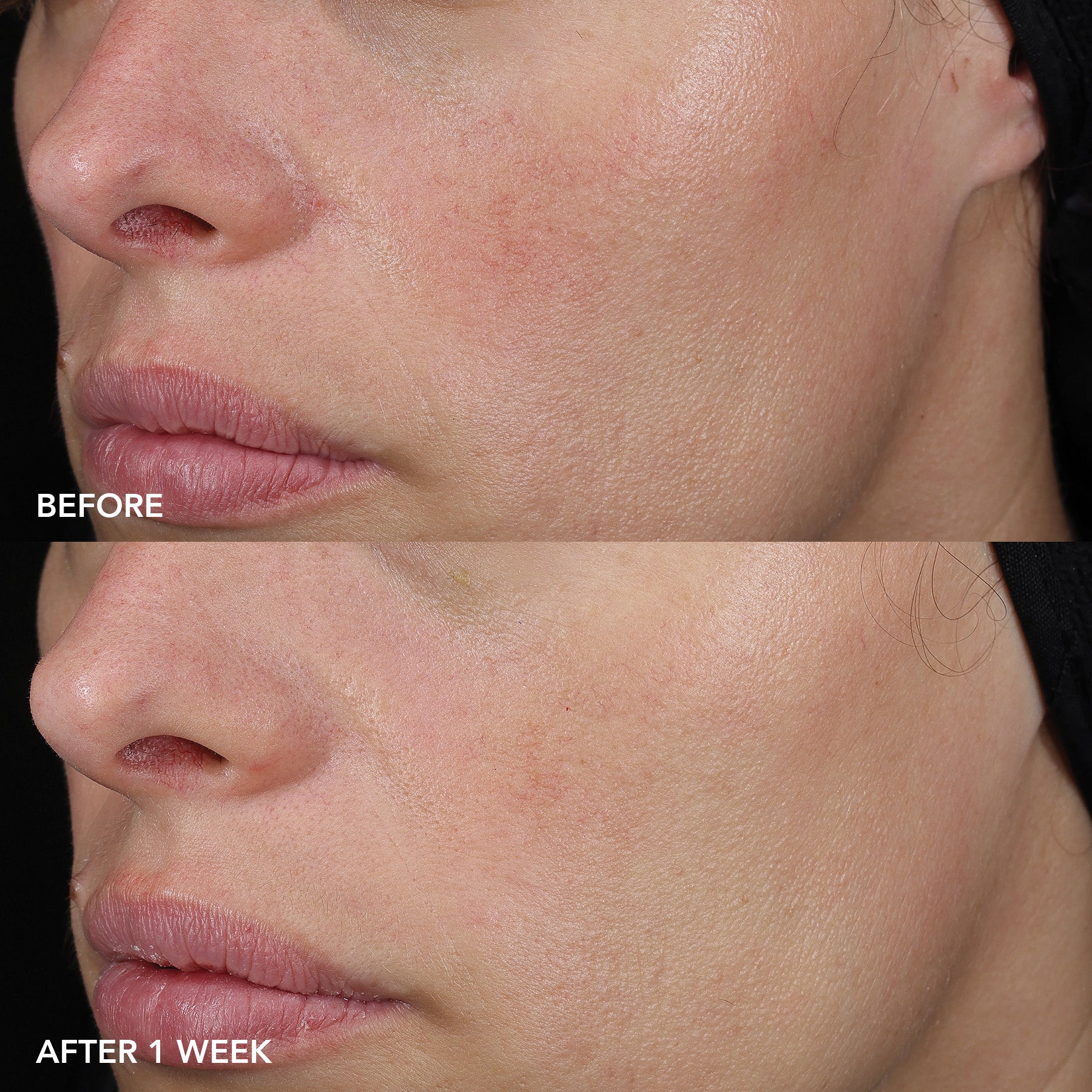 Before and after comparison of a person's face with acne scars, showing improvement after one week.