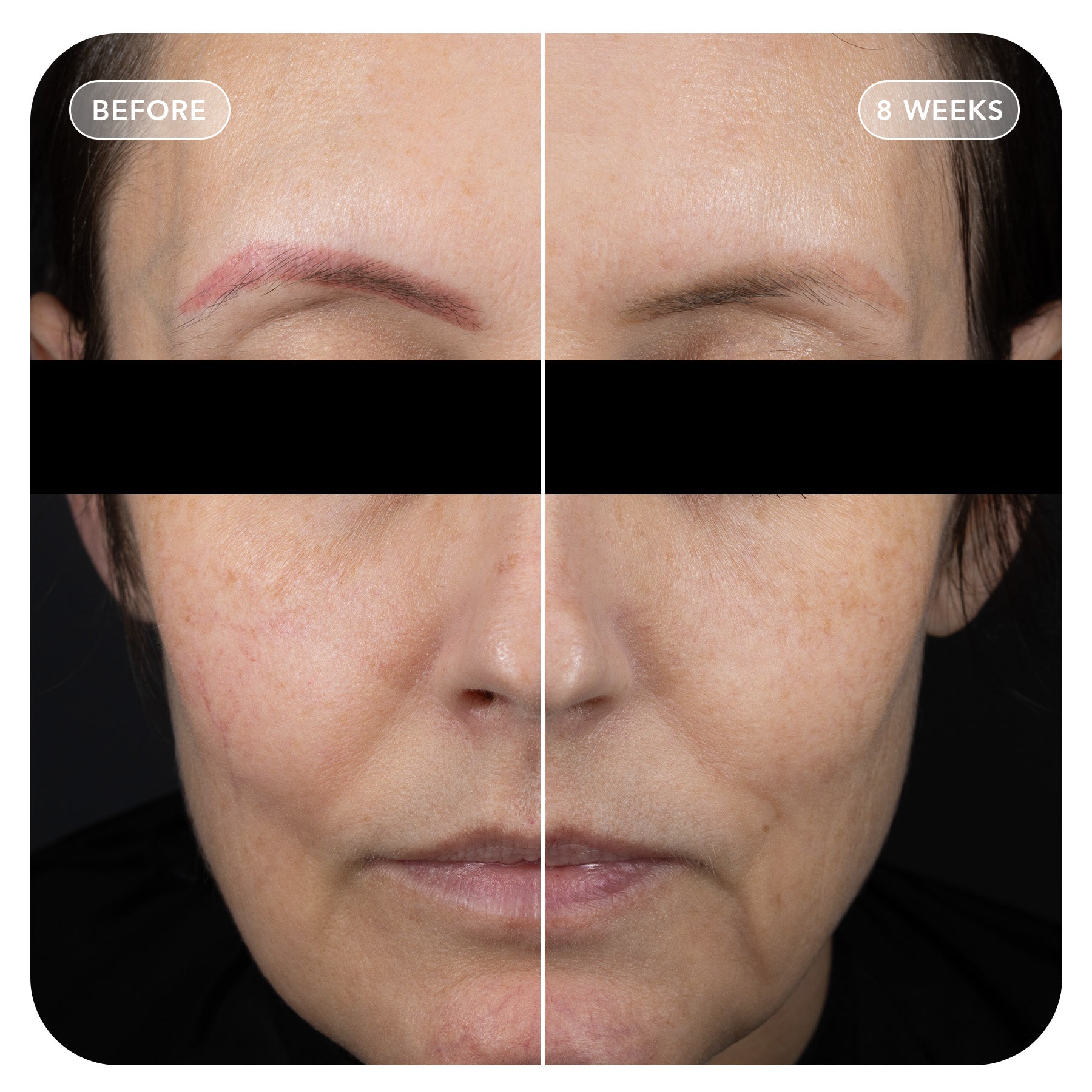 VOL.U.LIFT™ GLP-1 4D Skin Rebound Complex (3-pack)