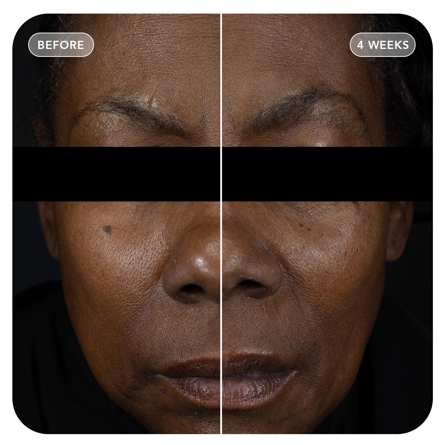 VOL.U.LIFT™ GLP-1 4D Skin Rebound Complex (3-pack)