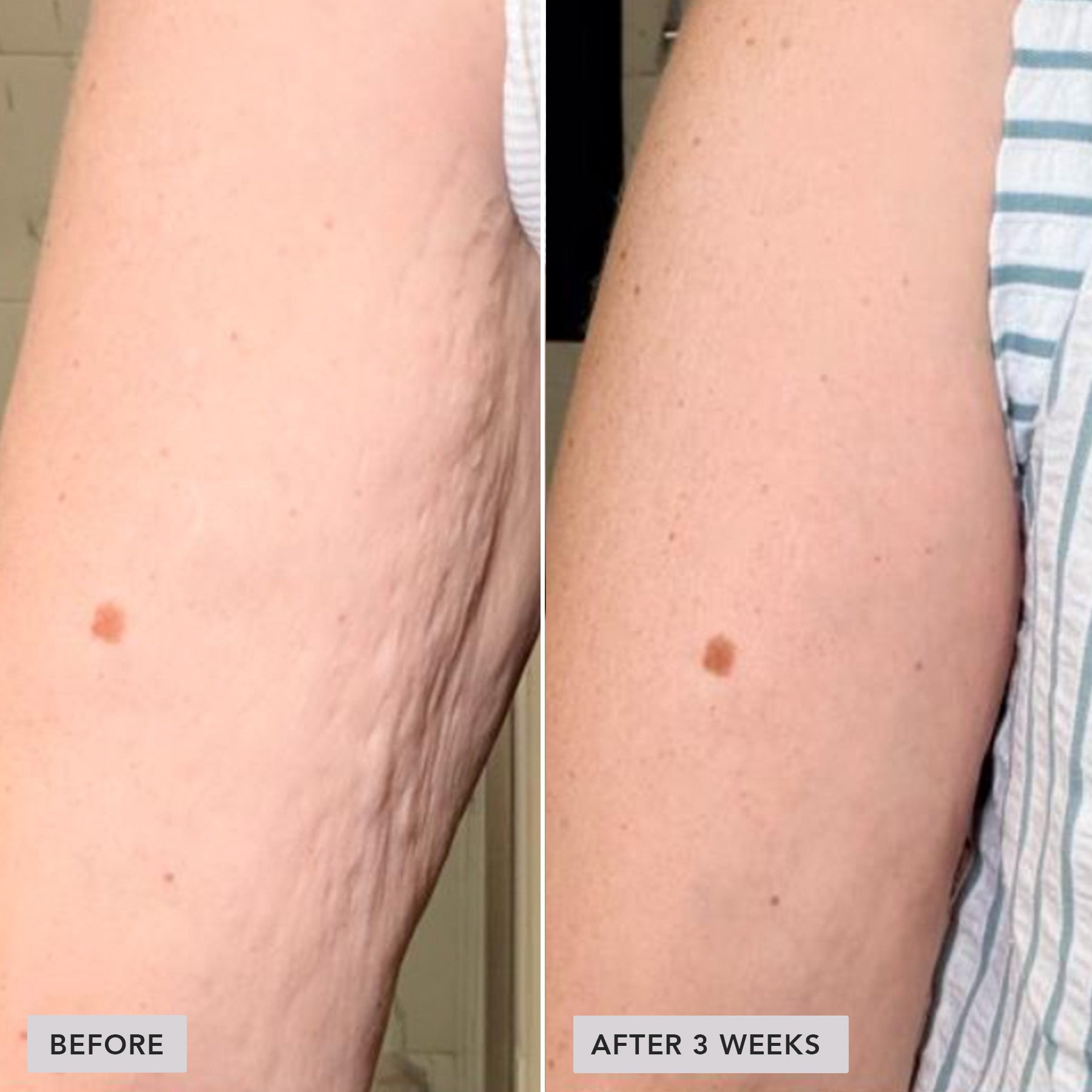 A side-by-side before and after comparison of a person's upper arm, showing stretch marks and skin texture improvement after 3 weeks. The left panel is labeled 'BEFORE' and the right panel 'AFTER 3 WEEKS'.