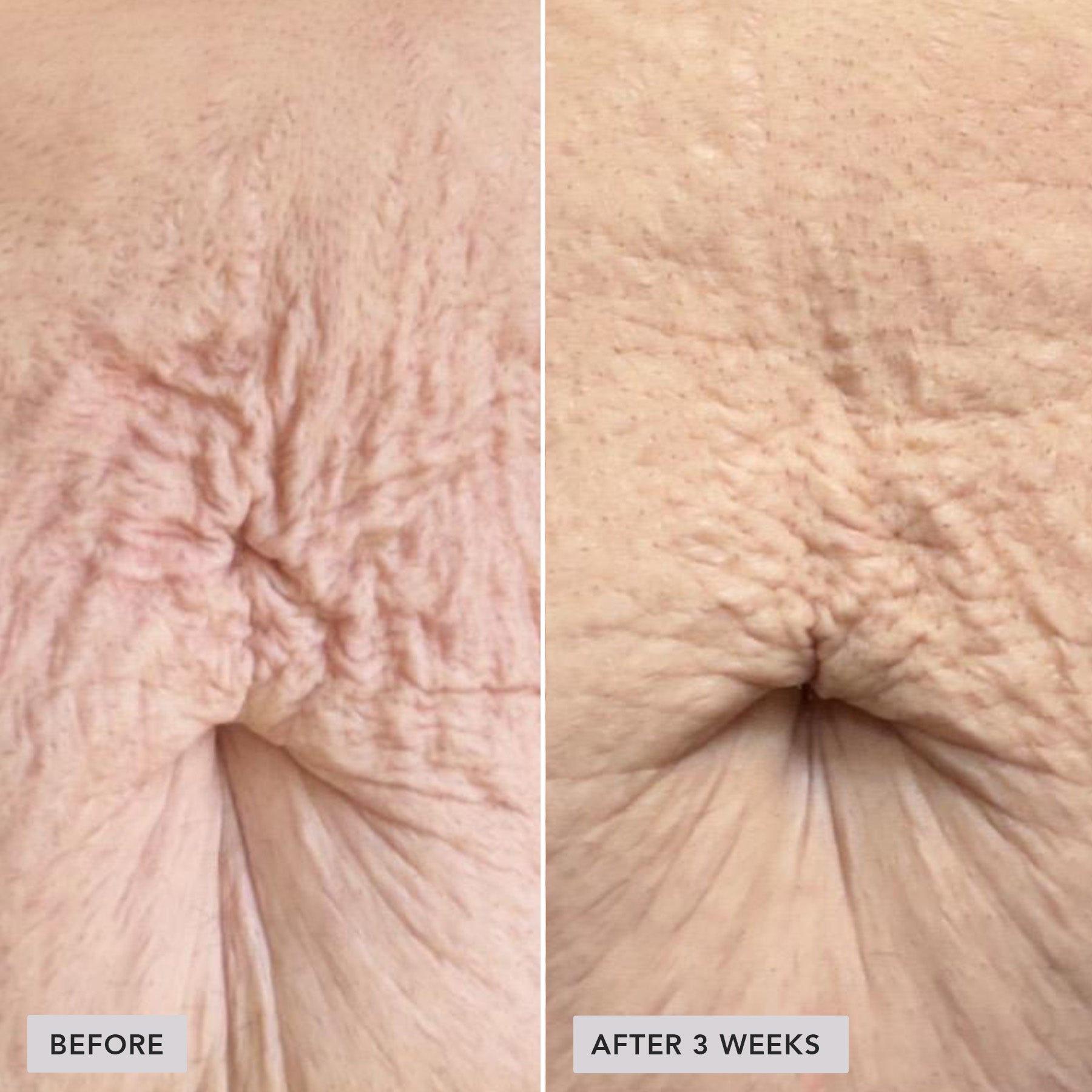 Before-and-after comparison of an abdominal hernia or umbilical hernia, showing skin tightening and reduction in wrinkling after 3 weeks.