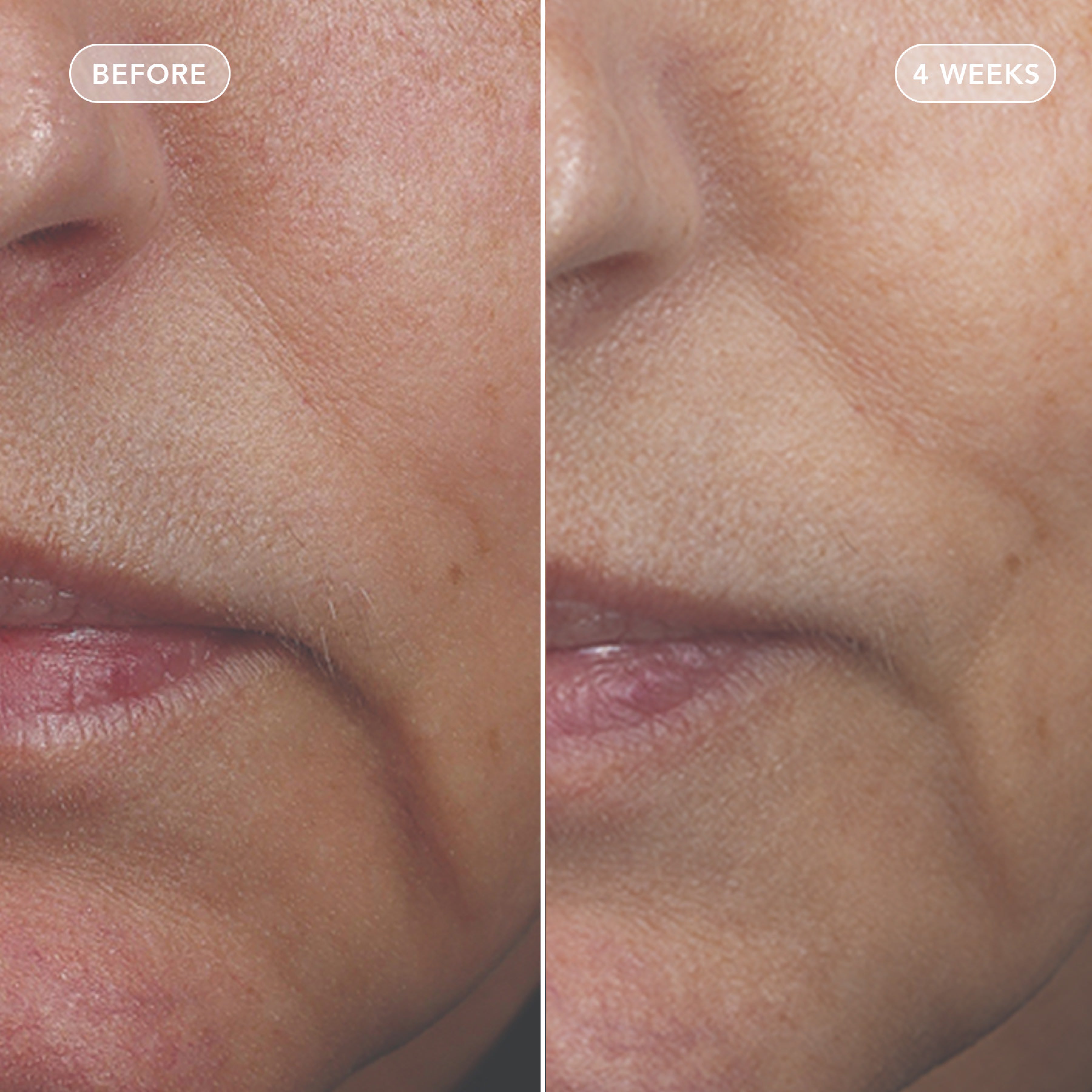 Close-up before-and-after comparison of a person's lower face, showing skin improvement over time with 'BEFORE' on the left and '4 WEEKS' on the right.